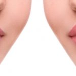 Filler Labbra Milano